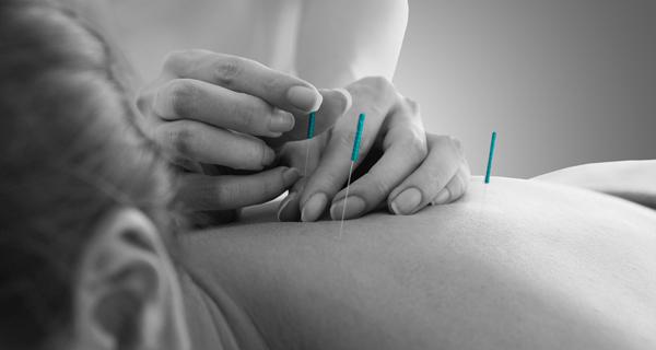acupuncture